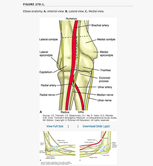 Distal Triceps Tendon Rupture