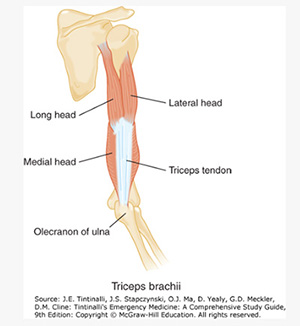 Distal Triceps Tendon Rupture