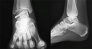 The Snowboarder's Fracture