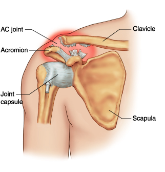 Acromioclavicular Reconstruction Bishop | AC CA