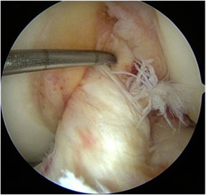 Primary Anterior Cruciate Ligament Repair: Current Concepts