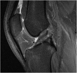 Primary Anterior Cruciate Ligament Repair: Current Concepts