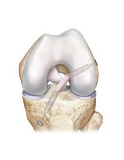 acl repair