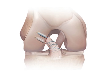 acl repair