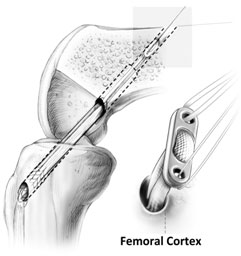 acl repair