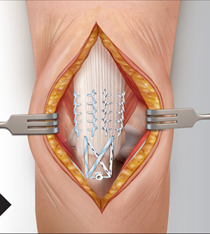 Distal Triceps Tendon Rupture