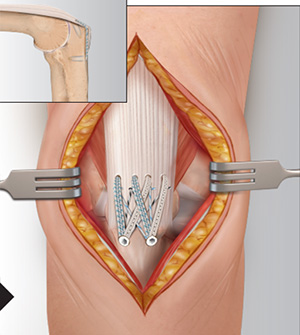 Distal Triceps Tendon Rupture