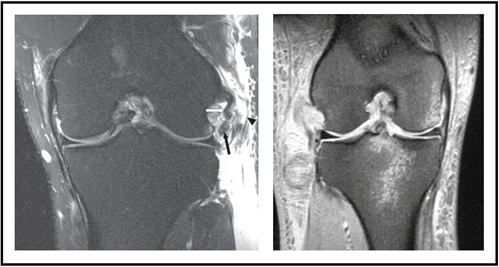 MRI depicting PLC Injury
