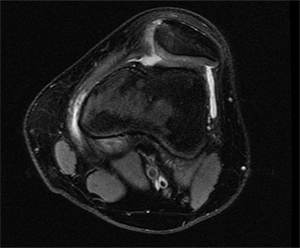 Trochlear Dysplasia