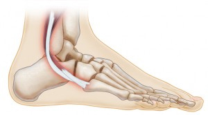 Peroneal Tendon Injuries