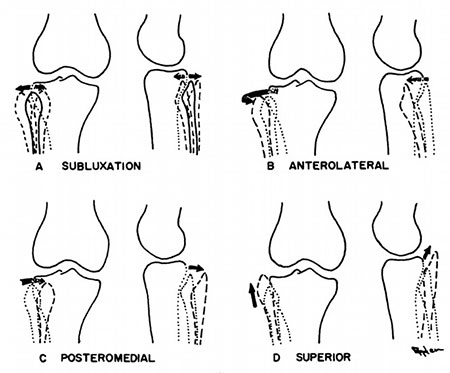 Proximal Tibiofibular Ligament Instability