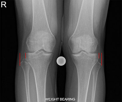 Proximal Tibiofibular Ligament Instability