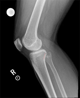 Proximal Tibiofibular Ligament Instability