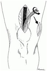 acl repair