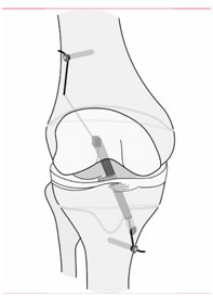 acl repair