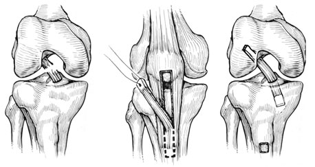 acl repair