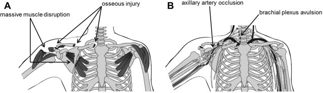 Scapulothoracic Dissociation Image