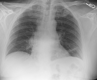 Scapulothoracic Dissociation Image