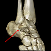 The Snowboarder's Fracture