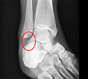Fracture talus Talar Fracture