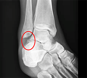 The Snowboarder's Fracture