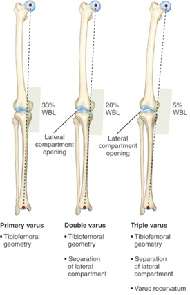 Triple Varus Alignment