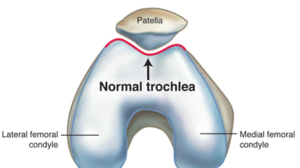 Trochlear Dysplasia