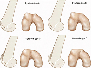 Trochlear Dysplasia