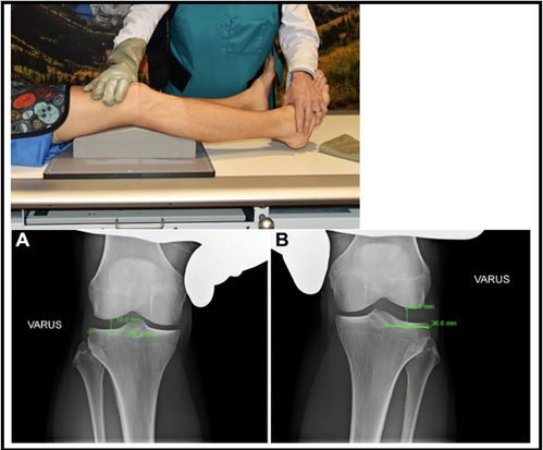 IT Band, Short and Long Heads of Biceps Femoris and Gastrocnemius Anatomy